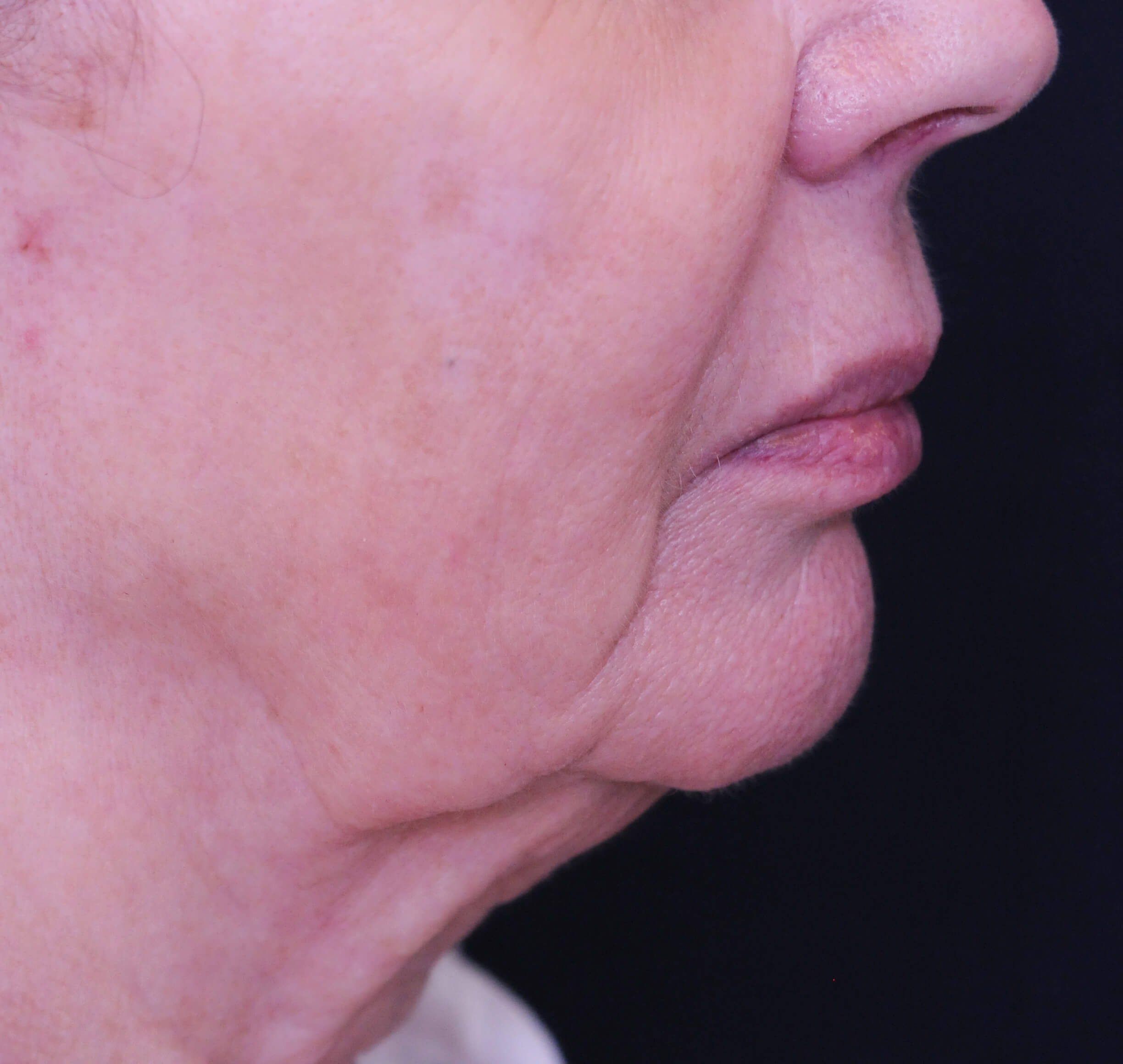 closeup on woman's chin, improved skin with less sagging