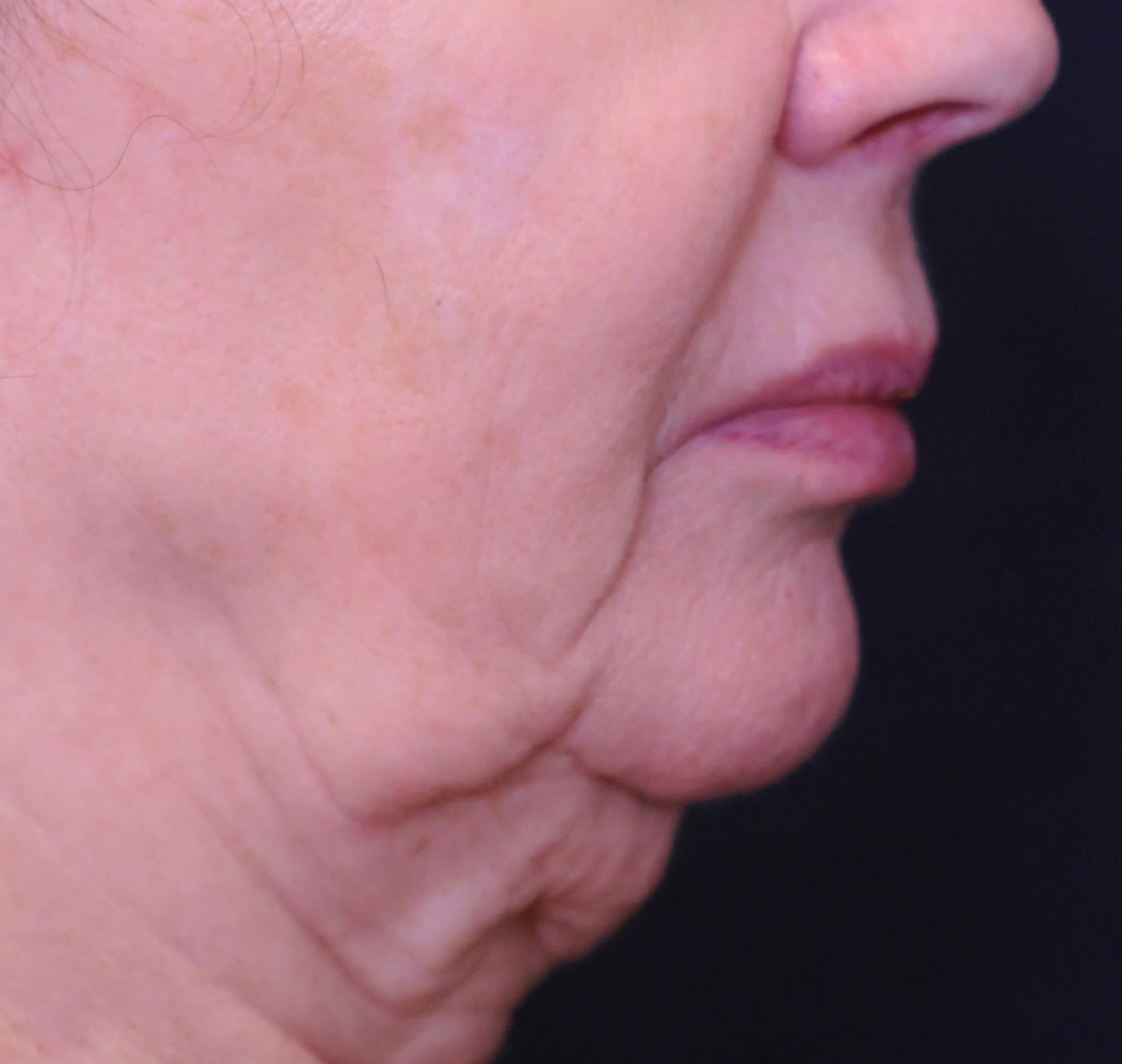 closeup on woman's chin, showing sagging skin
