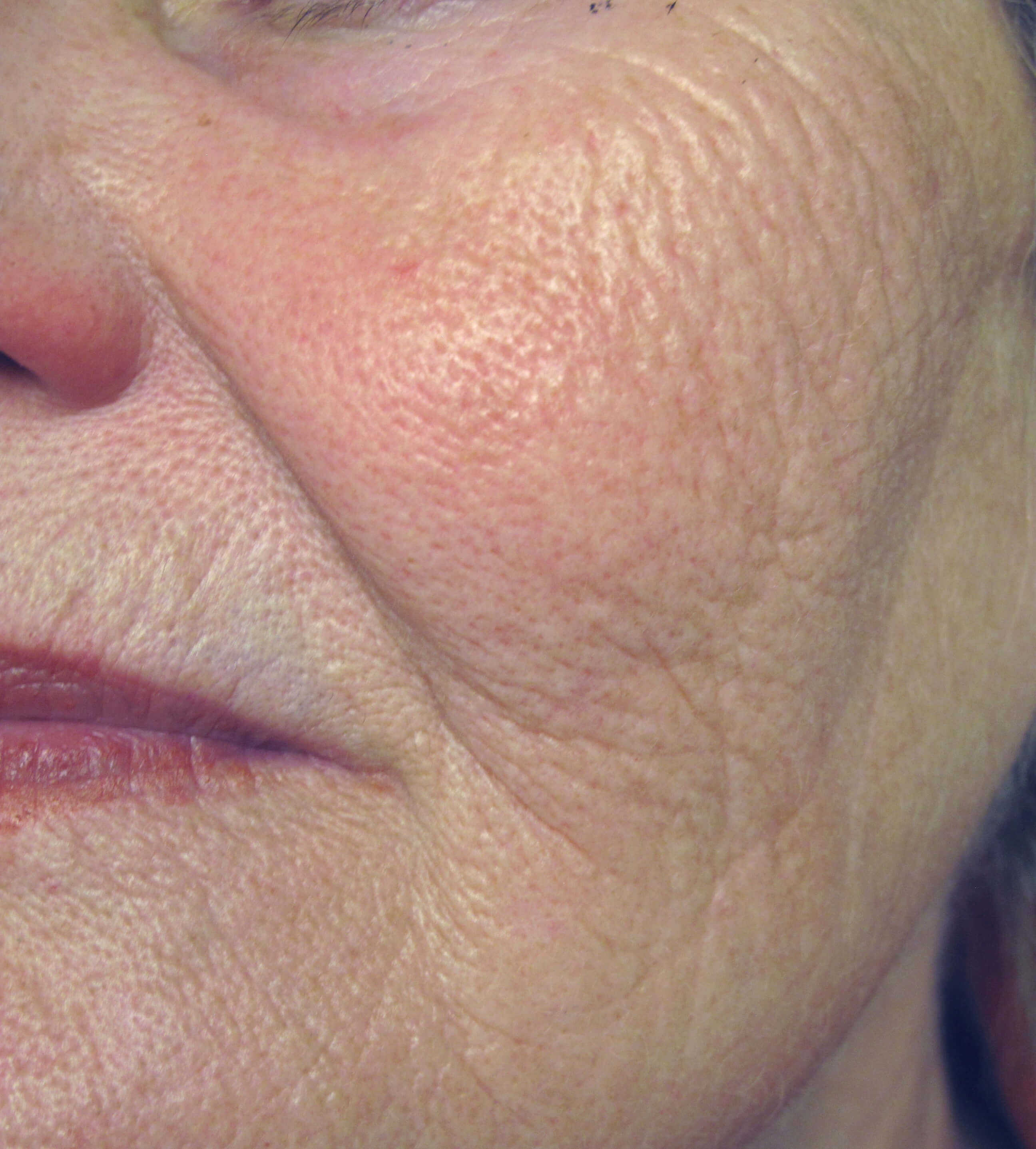 closeup of woman's face with fewer wrinkles
