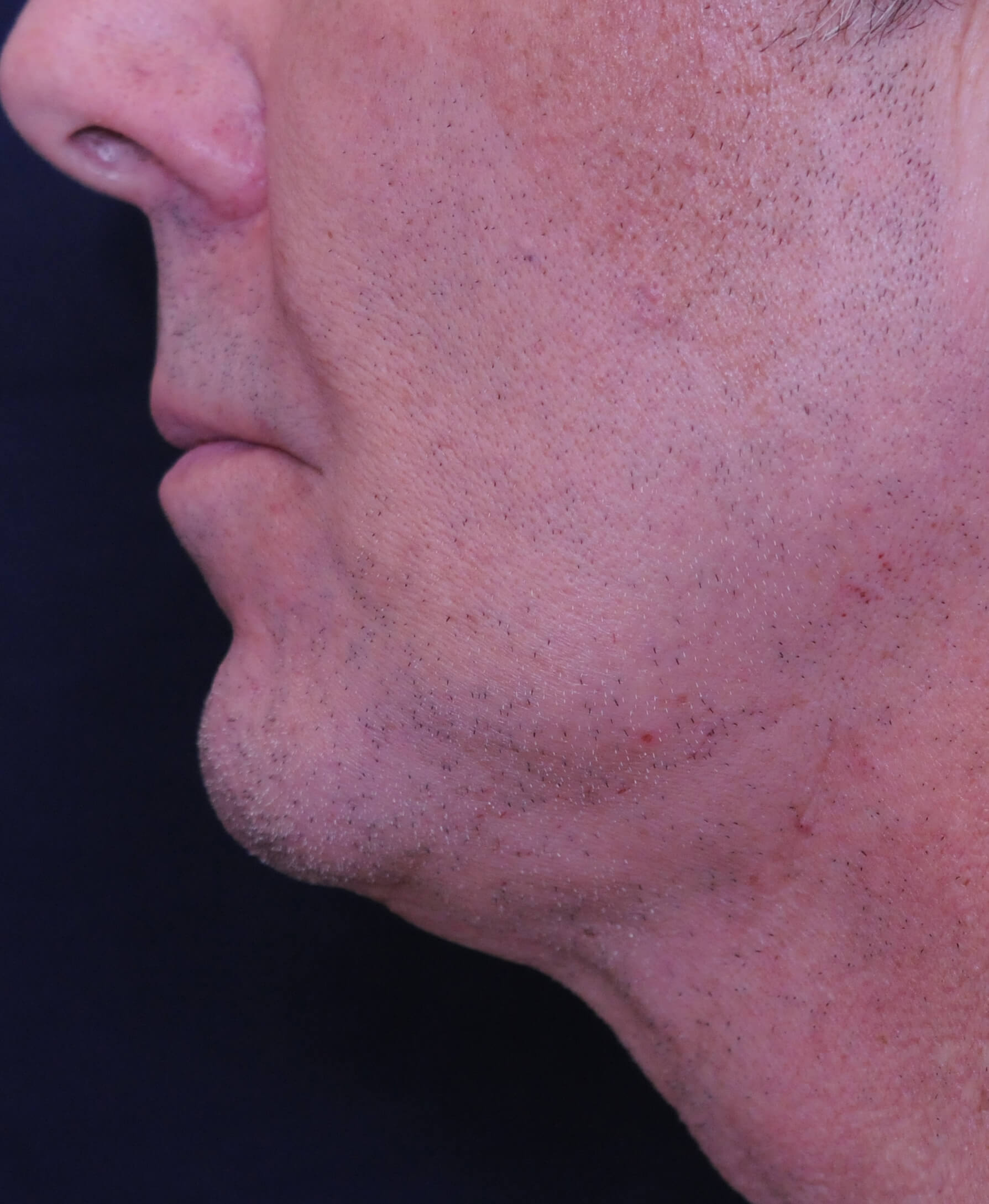 closeup on man's chin, improved skin with less sagging