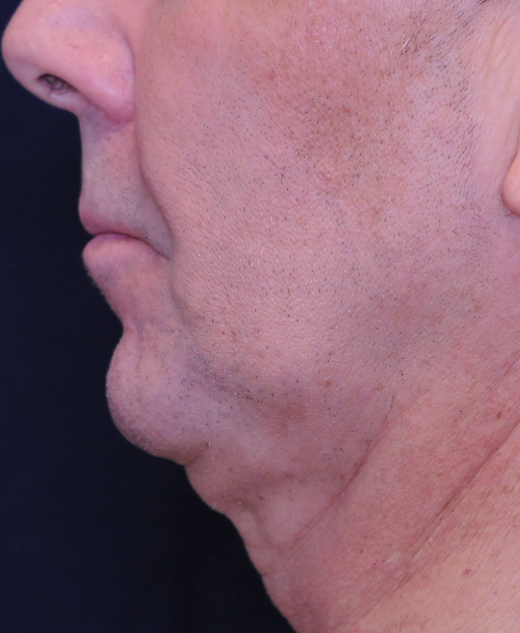 closeup on man's chin, showing sagging skin